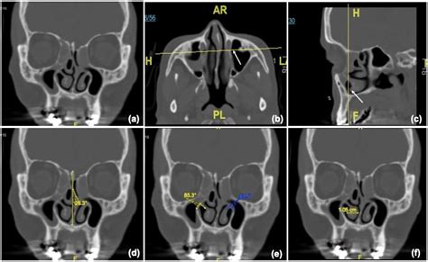 Nasolacrimal Duct Obstruction and Epiphora Workup 